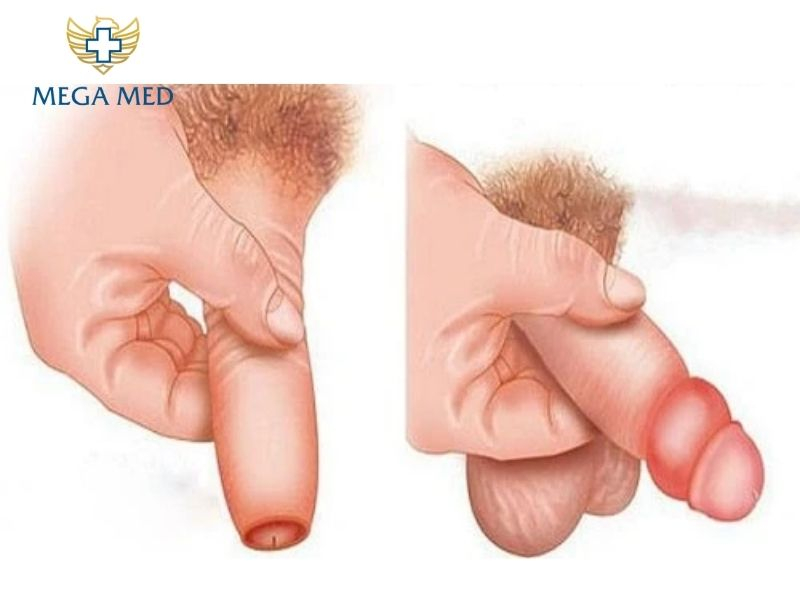 tuột bao quy đầu bị đau